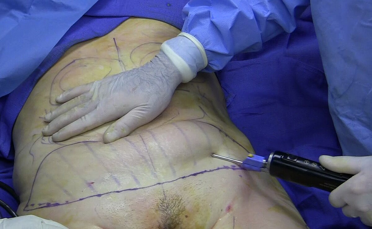 Liposuccin antes y despus abdomen esculpido