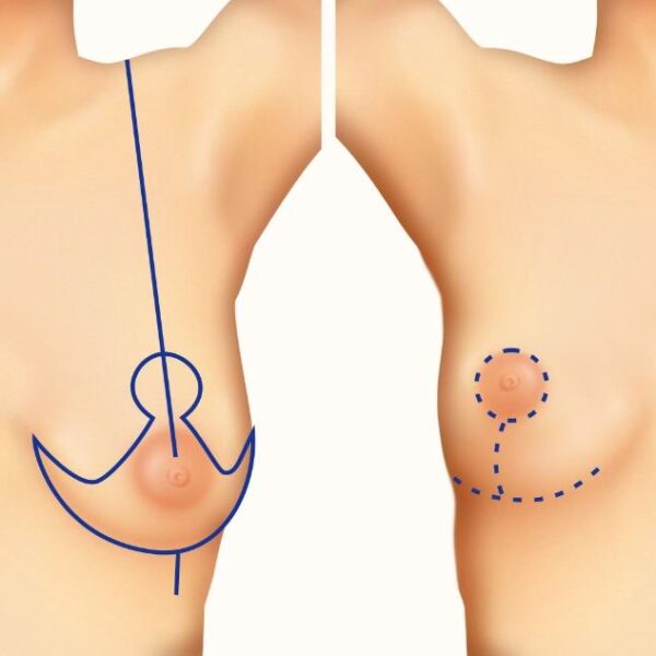 Diferencias Clave: Mastopexia Periareolar vs. Mastopexia en T Invertida