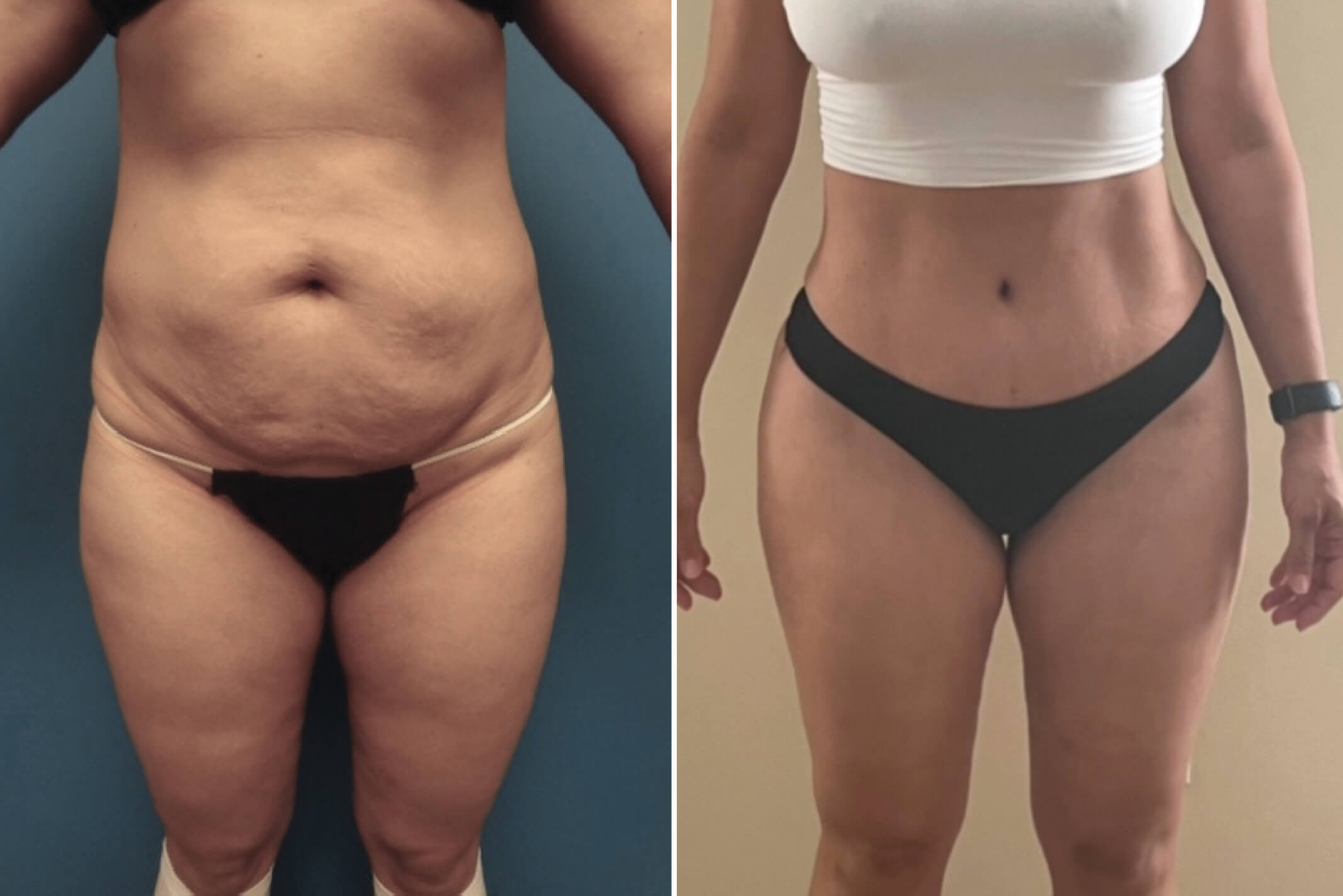 Mommy Makeover: transformación postparto del abdomen y senos