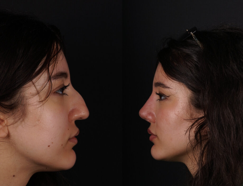 Rinoplastia antes y despus Mejora de la armona facial